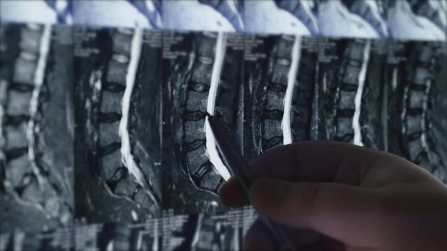 Doctor examines MRI of lumbar spine with pinched discs of spine and nerves, points at problem areas by pen, close-up