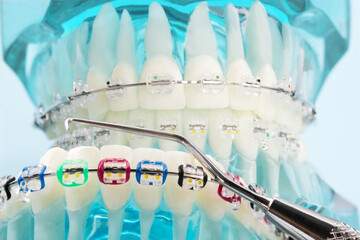 orthodontic model and dentist tool - demonstration teeth model of varities of orthodontic bracket or brace