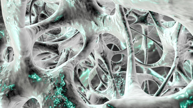 Osteoporotic trabecular bone