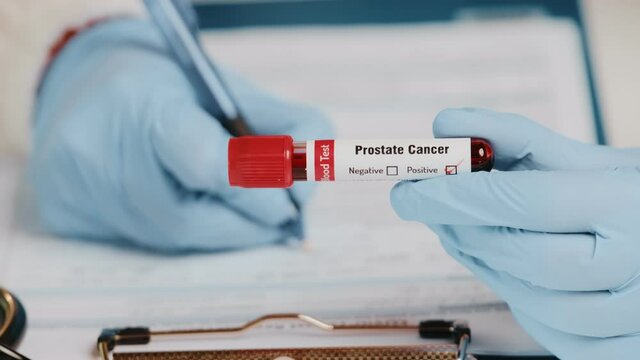 Doctor or laboratory technician holds in one hand laboratory positive blood test tube for cancer prostate, other hand writing down results to patients medical record. Laboratory medical diagnostics