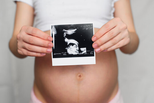 photo of a pregnant ultrasound in the hands of a pregnant girl