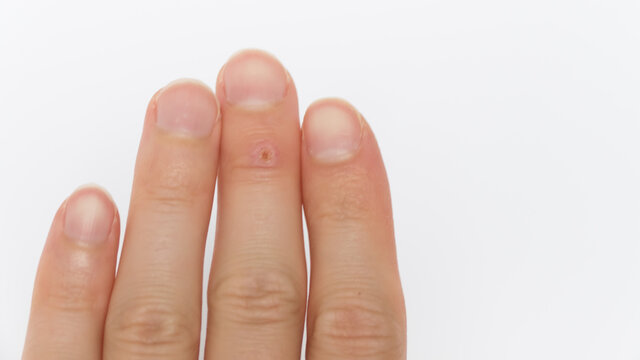 warts, corns on the middle finger on a man's hand with overgrown nails