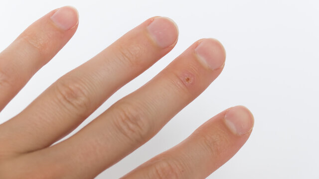 warts, corns on the middle finger on a man's hand with overgrown nails