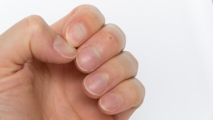 warts, corns on the middle finger on a man's hand with overgrown nails