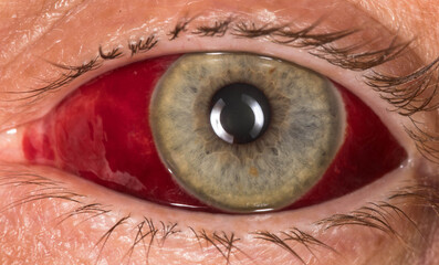 Bloodshot eye after an injection into the eyeball, medical malpractice