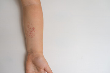 Blutschw&auml;mmchen eines dreieinhalbj&auml;hrigen Kindes