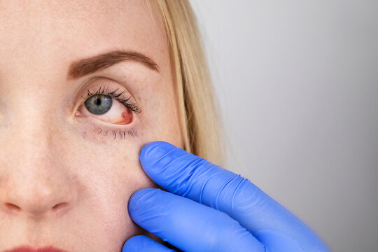 An Ophthalmologist Examines A Woman Who Complains Of A Burning Sensation And Pain In Her Eyes. Eye Fatigue From A Computer Screen Or Telephone (sand Sensation On The Cornea)