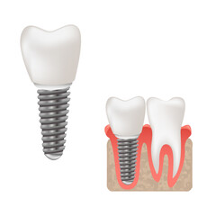 Dental implant and healthy teeth scientific modern design, realistic vector illustration