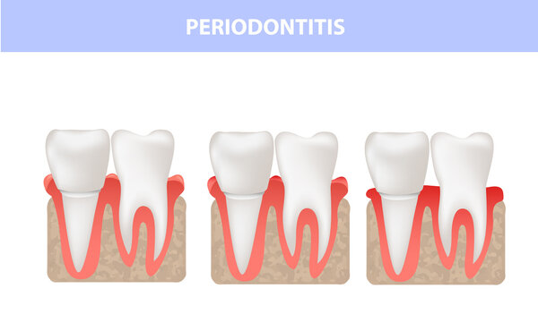 Periodontitis, gum disease, medical illustration