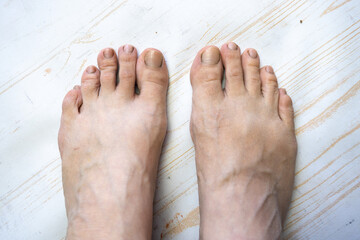 bare feet of caucasian female in bad condition, dry unhealthy toes with dirty damaged nails