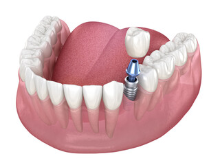 Premolar tooth recovery with implant. Medically accurate 3D illustration of human teeth and dentures concept