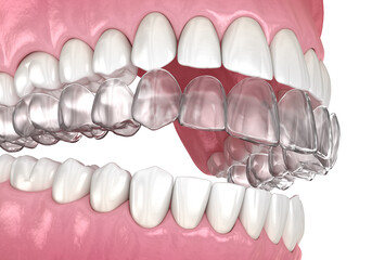 Invisalign braces or invisible retainer. Medically accurate dental 3D illustration