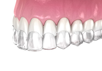 Invisalign braces or invisible retainer. Medically accurate dental 3D illustration