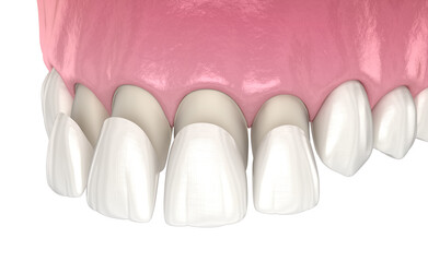 Veneer installation procedure over central incisor and lateral incisor. Medically accurate tooth 3D illustration