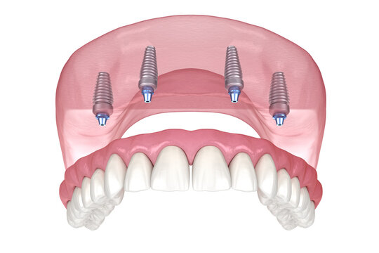 Maxillary prosthesis with gum All on 4 system supported by implants. Medically accurate 3D illustration of human teeth and dentures