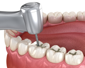 Fissure Preparation for fillings placement, Medically accurate 3D illustration of dental concept