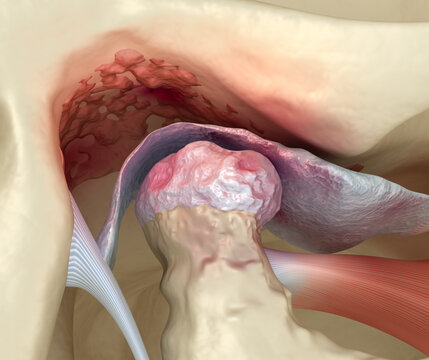 Temporomandibular joints arthritis and dislocated articular disc. Medically accurate 3D illustration.