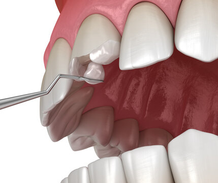 Restoration of broken tooth. Medically accurate 3D illustration.