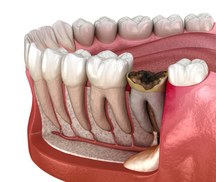 Periostitis tooth - Lump on Gum Above Tooth. Medically accurate dental 3D illustration