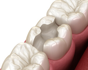 Inlay ceramic crown installation in to the tooth. Medically accurate 3D illustration of human teeth treatment