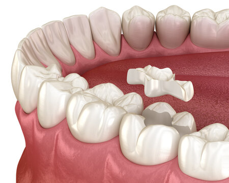 Inlay ceramic crown installation in to the tooth. Medically accurate 3D illustration of human teeth treatment