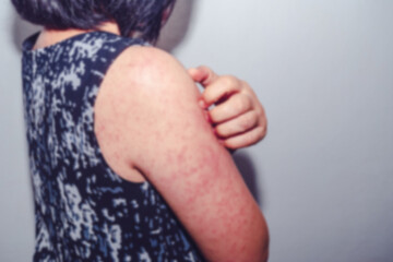 Blurred images of dermatitis from the measles virus, a woman with dermatitis from her itchy blister on her back, urticaria, health problems, Kawasaki disease linked to the Coronavirus. - obrazy, fototapety, plakaty