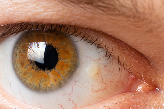 Pinguecula eyes macro photo close-up of the male eye. Yellow education on squirrel, farmer's eye