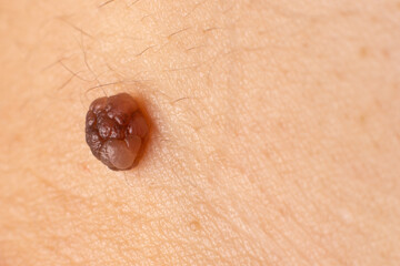 Mole birthmark nevus macro photo on human skin. Close up.