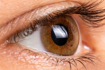Macro eye photo. Keratoconus - eye disease, thinning of the cornea in the form of a cone. The...