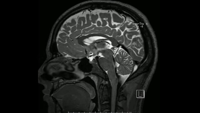 Magnetic resonance  images of the brain (MRI brain) sagittal T2 weighted sequence in cine mode showing normal anatomy