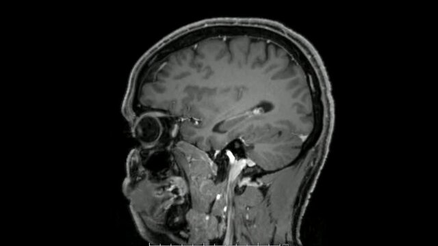 Magnetic resonance  images of the brain (MRI brain) sagittal post contrast sequence in cine mode showing normal anatomy