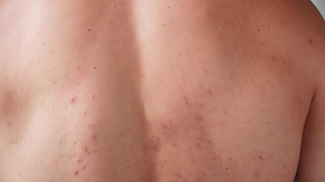 The man's back is covered in acne and pimples. Skin problems. Dermatology. Body care