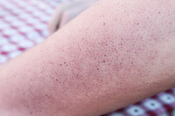 Trockene Haut an einem Arm die dringend Pflege braucht
