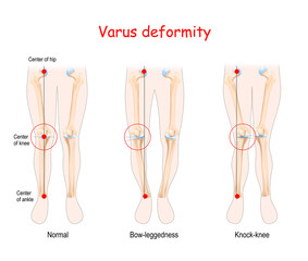 valgus deformities. healthy joint, knock-knee and Bow-leggedness. - obrazy, fototapety, plakaty