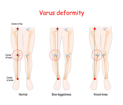 valgus deformities. healthy joint, knock-knee and Bow-leggedness.