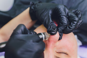 Woman cleaning nose skin pores using vacuum blackhead remover, cosmetic procedure.