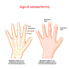 Sign of osteoarthritis. Human hand with Heberden's node and Bouchard's node.