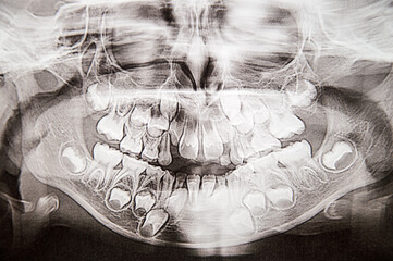 Close up. A panoramic view of the jaw of a 5 year old child. Change of milk teeth to permanent ones. Medical research, aesthetic dentistry, orthodontics.