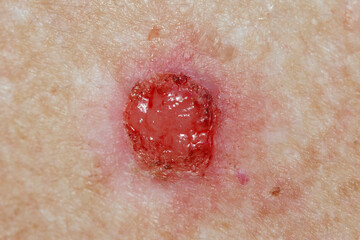 Basal Cell pre-treatment - sore open wound with constant weeping and bleeding. 