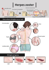 Herpes zoster medical illustration