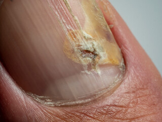 Fototapeta premium Nail infections caused by fungi such as: onychomycosis also known as tinea unguium. Thumb infection. Caused by dermatophytes and yeasts and for the concomitant antibacterial activity