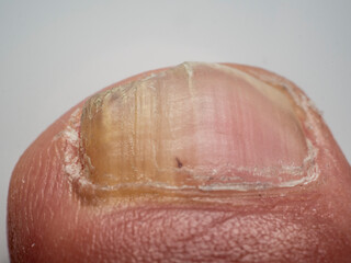Fototapeta premium Nail infections caused by fungi such as: onychomycosis also known as tinea unguium. Caused by dermatophytes and yeasts and for the concomitant antibacterial activity
