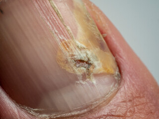 Fototapeta premium Nail infections caused by fungi such as: onychomycosis also known as tinea unguium. Thumb infection. Caused by dermatophytes and yeasts and for the concomitant antibacterial activity
