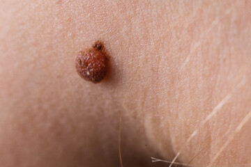 Closeup brown mole on caucasian woman skin.