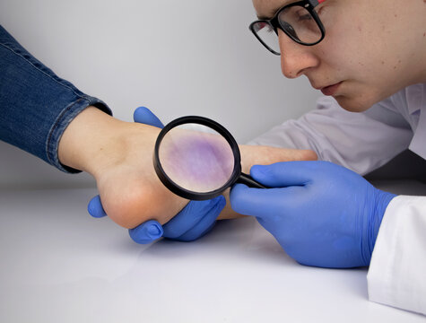 A woman in consultation with a vascular surgeon. A doctor examines a leg with swollen veins. Varicose veins on the leg