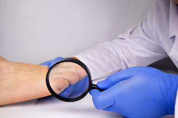 A trichologist examines a toenail with a magnifying glass, which is affected by the fungus....