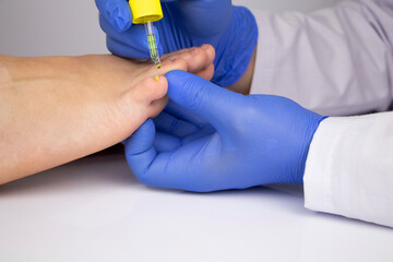 The doctor dermatologist drops the medicine with a pipette on the nail affected by the fungus....