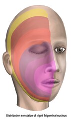 the onion skin pattern of facial sensation regarding to right trigeminal nucleus lesion in brain stem