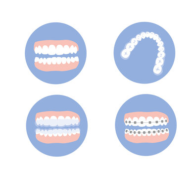 Orthodontic set of jaws with teeth while treatment. Brace and retainer on teeth. Flat vector illustration.