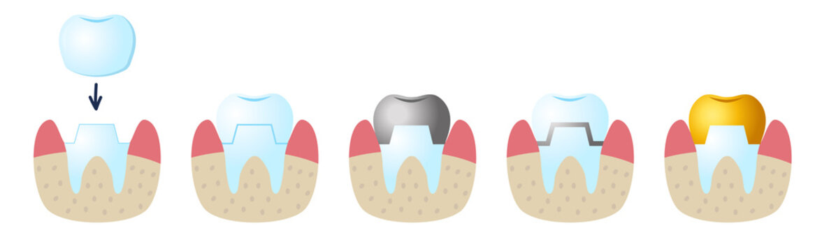 Icons On The Dental Theme. Service Installation Of A Ceramic Crown. As Well As A Metal And Gold Crown On The Tooth. Set Icons Flat Style.